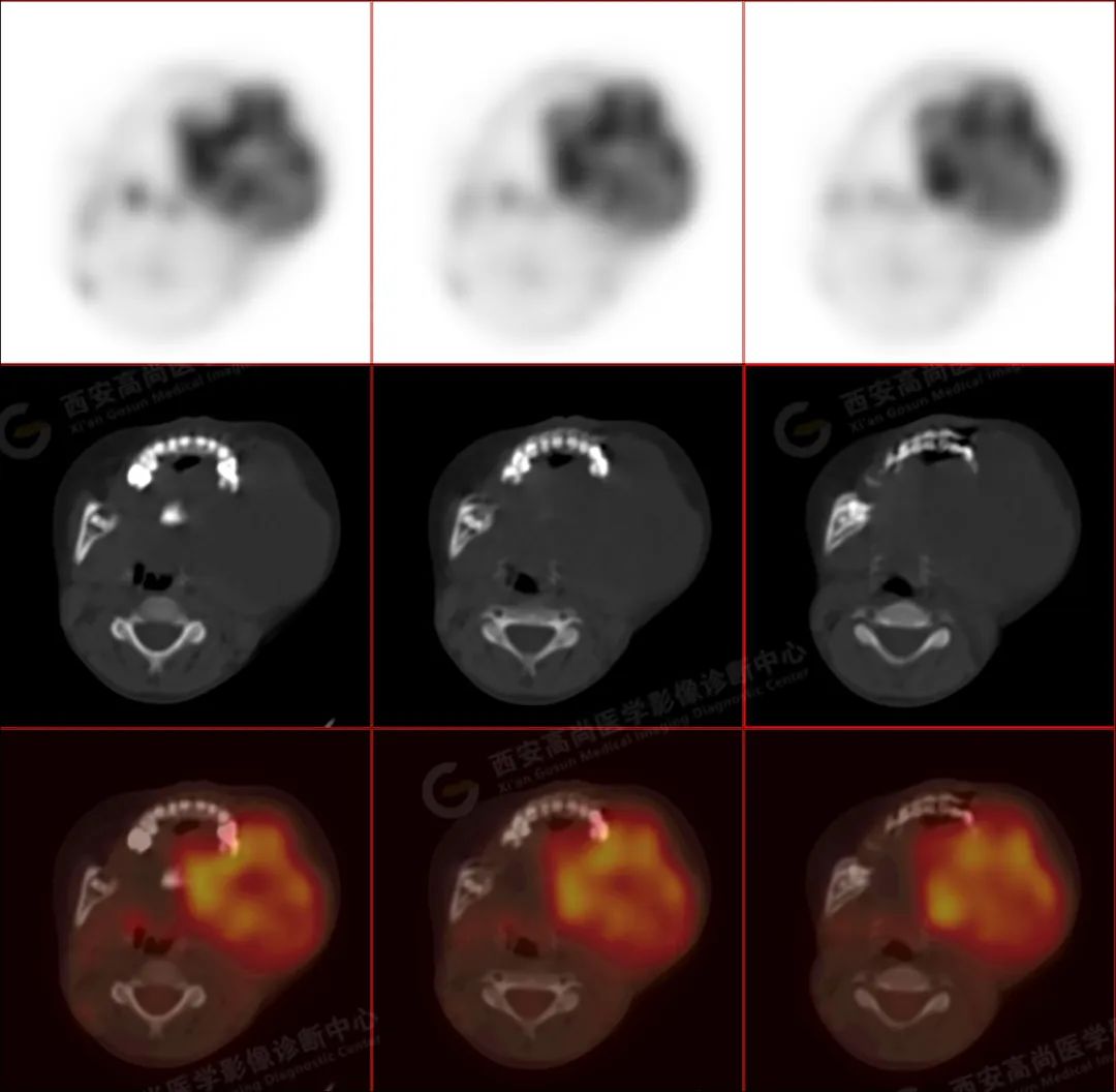 高尚病例:PET/CT 病例-儿童颌面部横纹肌肉瘤 1 例