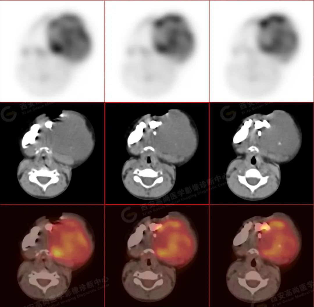 高尚病例:PET/CT 病例-儿童颌面部横纹肌肉瘤 1 例