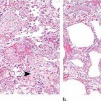 肺间质纤维化动物模型  