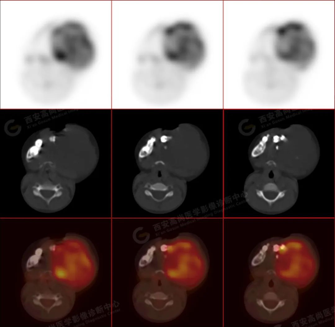 高尚病例:PET/CT 病例-儿童颌面部横纹肌肉瘤 1 例