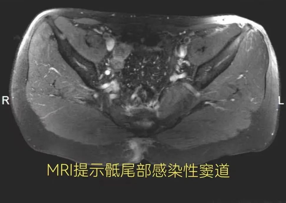 一根毛发引起的「血案」！郑大五附院手术切除「藏毛窦」