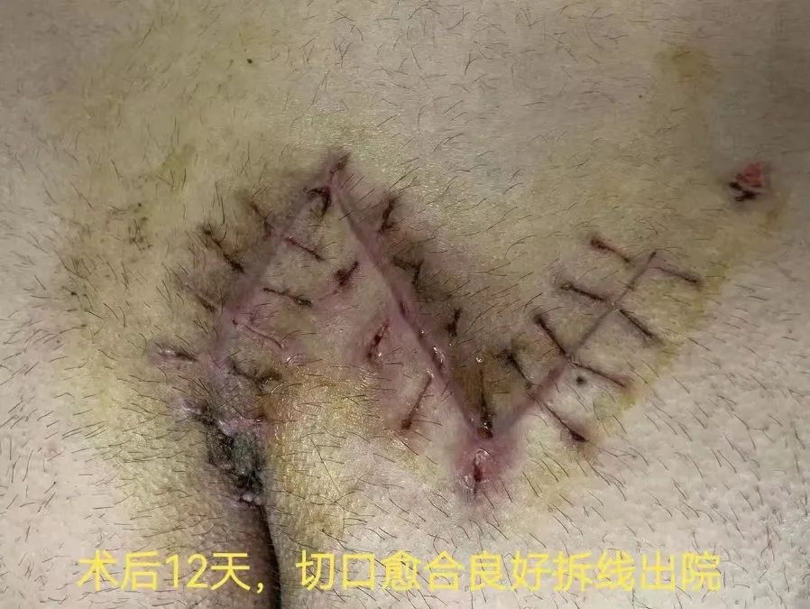 一根毛发引起的「血案」！郑大五附院手术切除「藏毛窦」