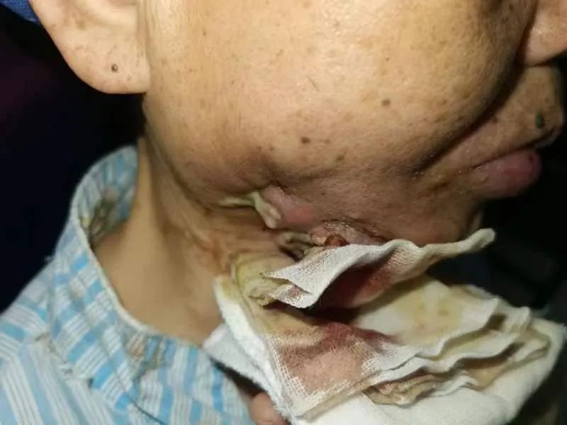 湘潭市第一人民医院耳鼻喉科成功为一名晚期口腔癌」熊猫血」患者实施挽救性手术