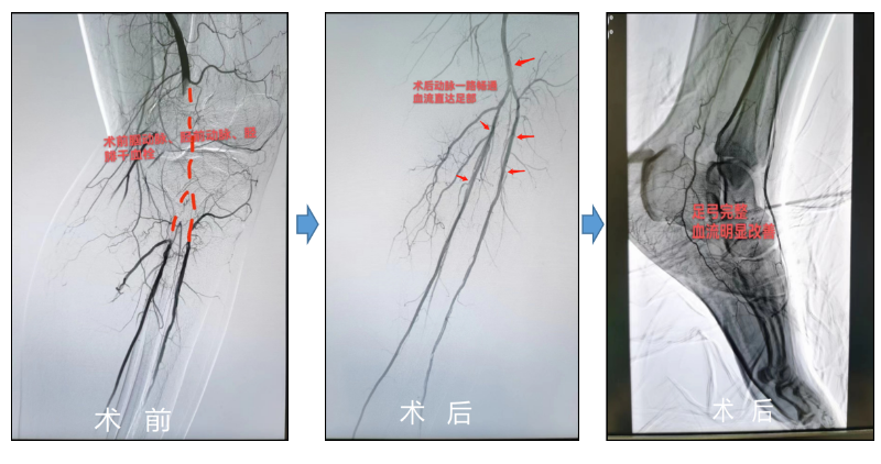 广西壮族自治区人民医院运用外周血管介入微创技术救治脉管炎患者