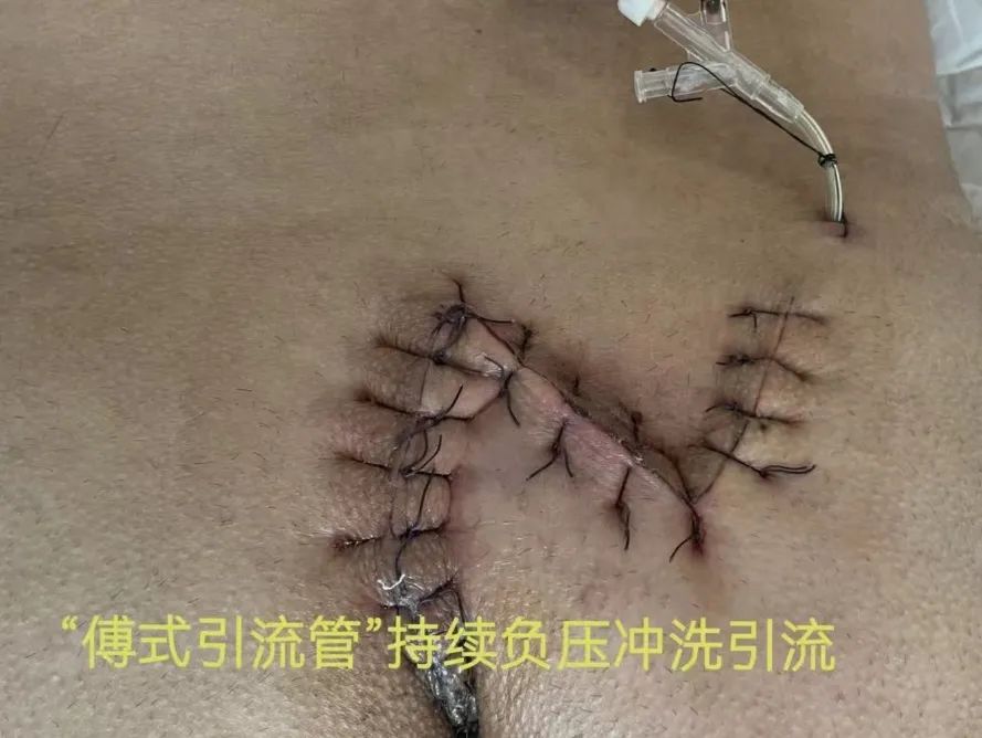 一根毛发引起的「血案」！郑大五附院手术切除「藏毛窦」