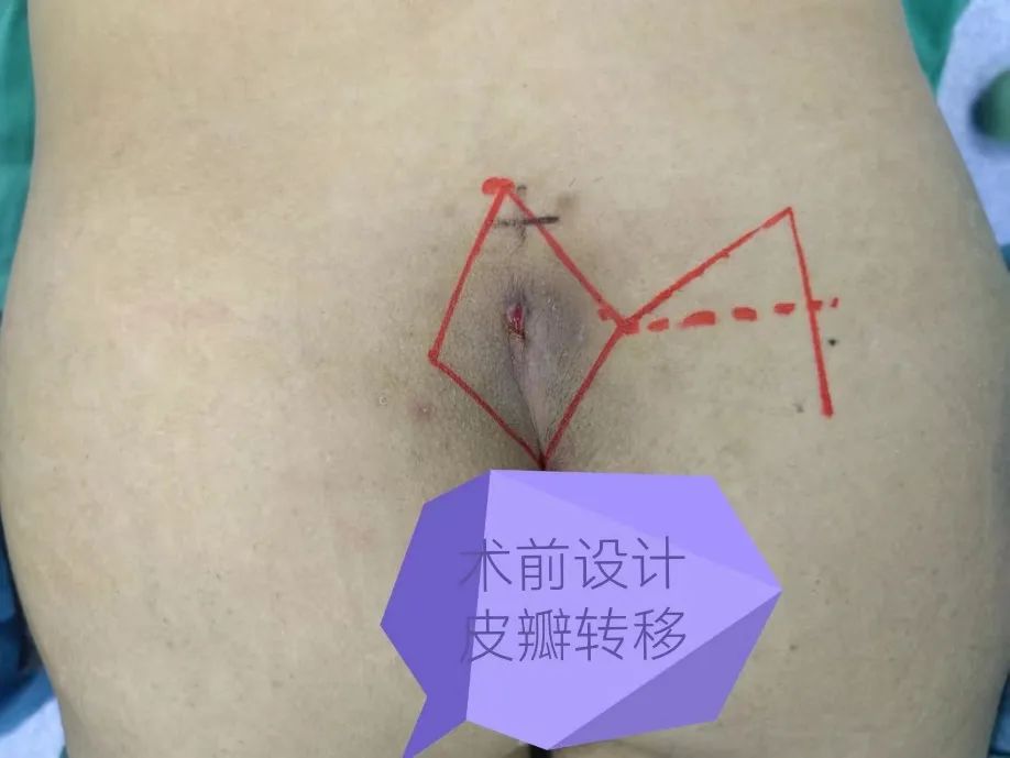 一根毛发引起的「血案」！郑大五附院手术切除「藏毛窦」