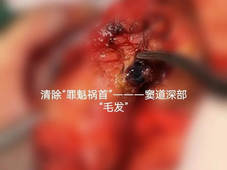 一根毛发引起的「血案」！郑大五附院手术切除「藏毛窦」