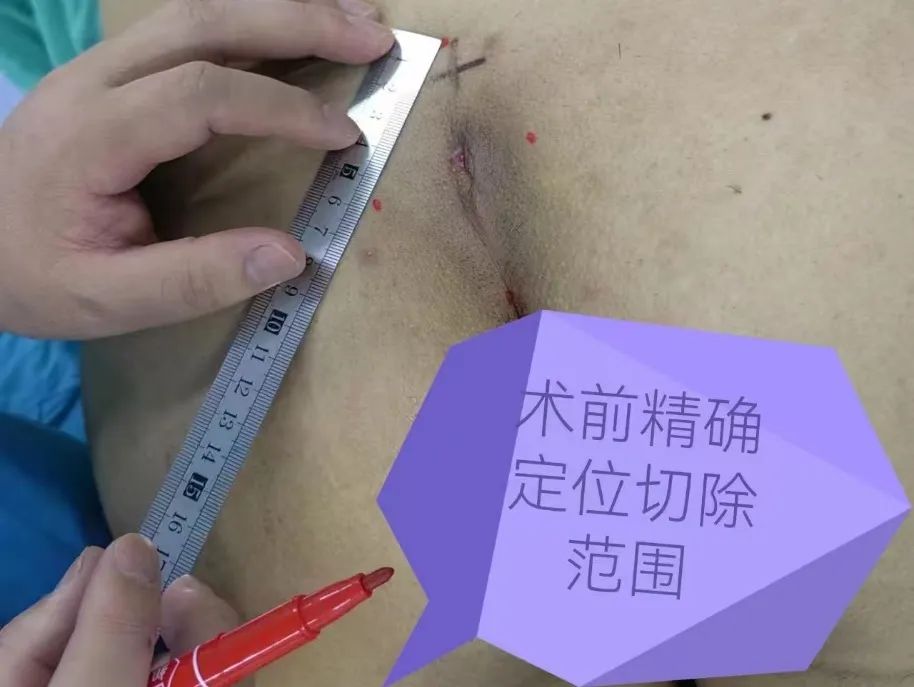 一根毛发引起的「血案」！郑大五附院手术切除「藏毛窦」