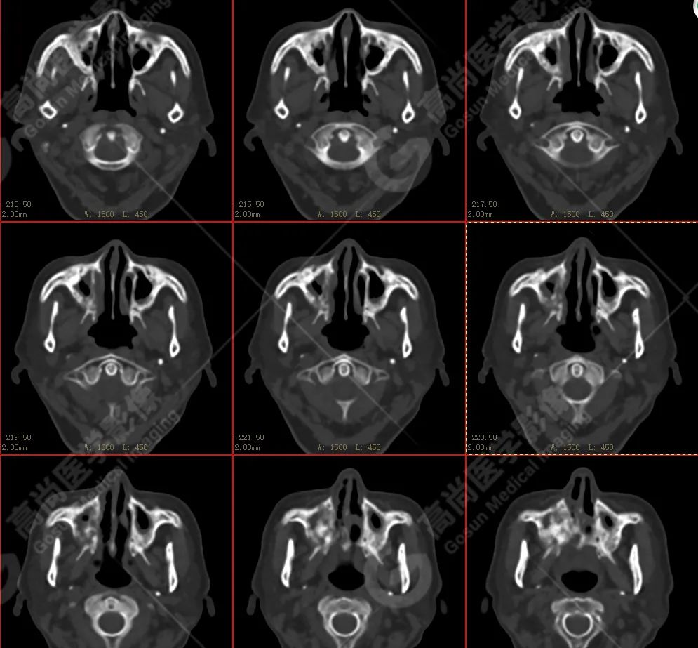 高尚病例：放疗后骨肉瘤一例