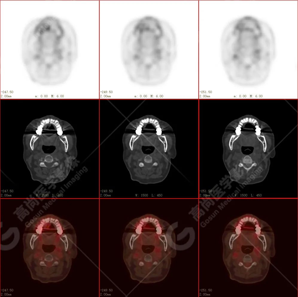 高尚病例：放疗后骨肉瘤一例