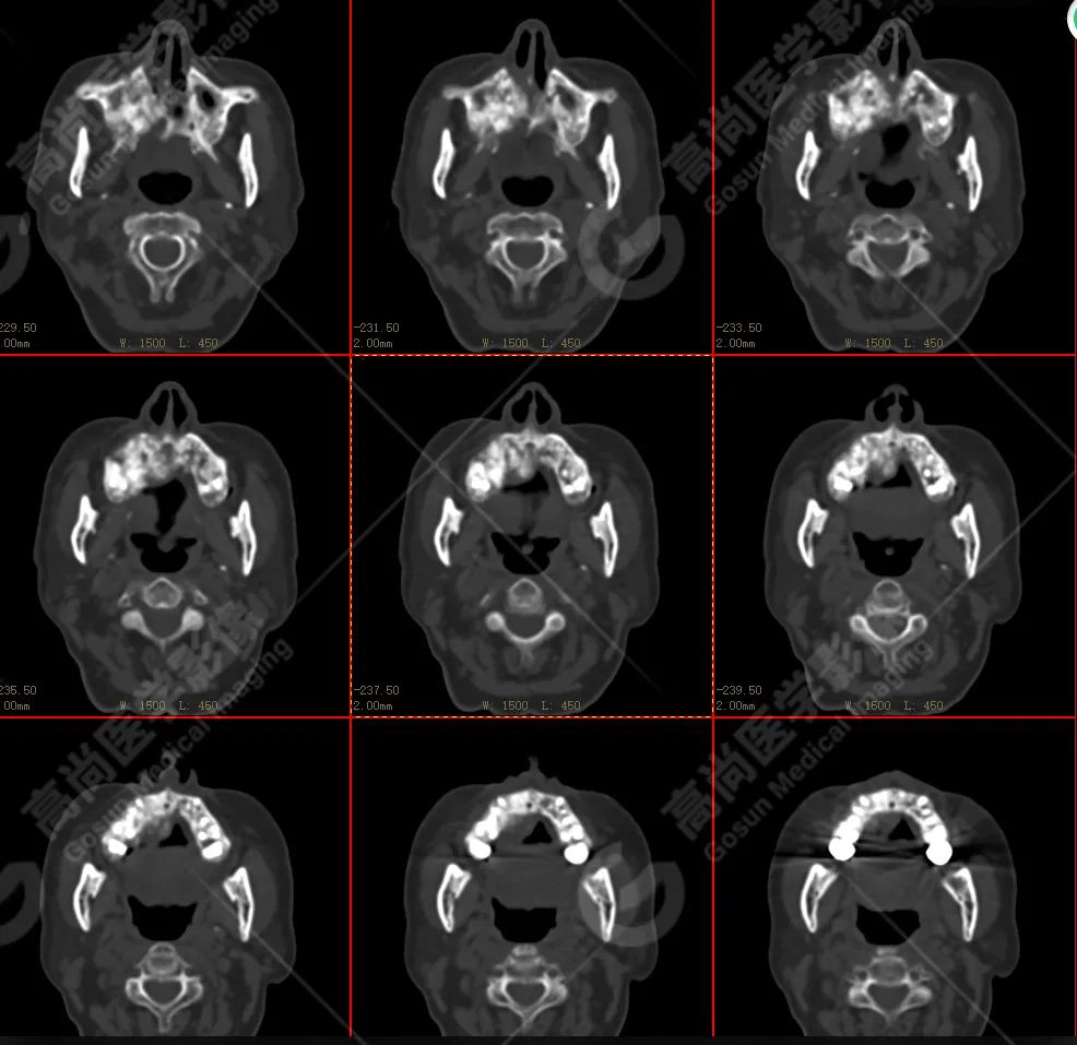高尚病例：放疗后骨肉瘤一例
