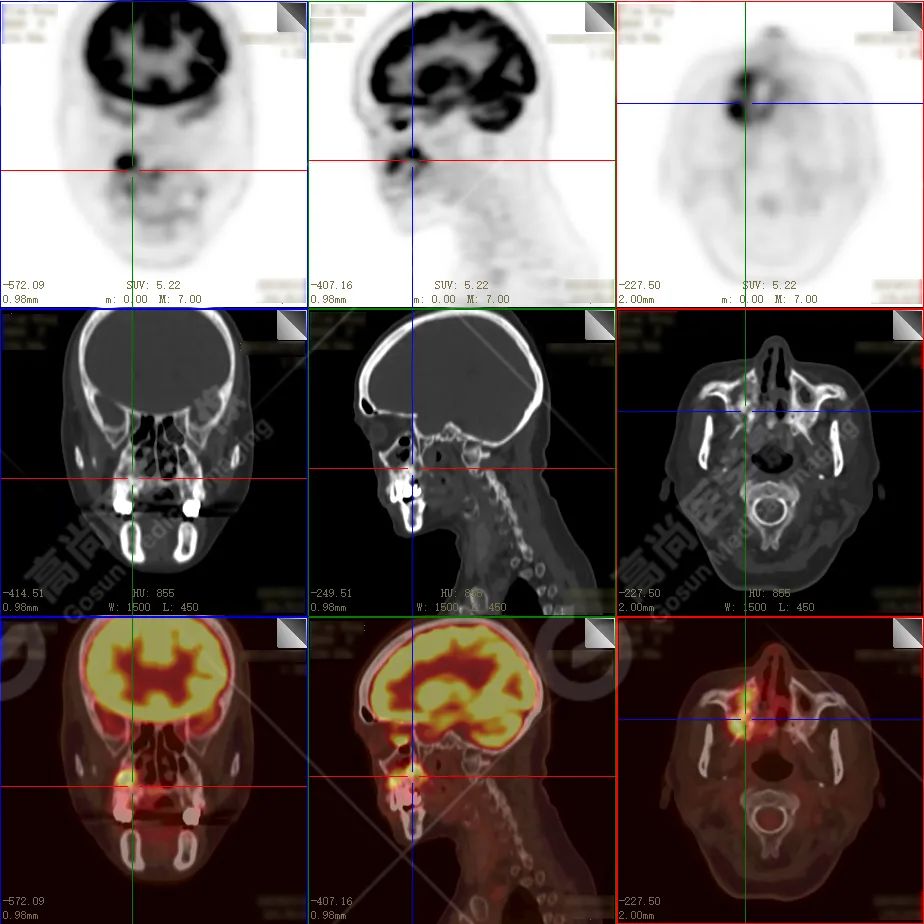 高尚病例：放疗后骨肉瘤一例