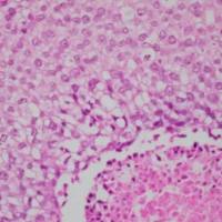 裸鼠乳腺癌原位瘤