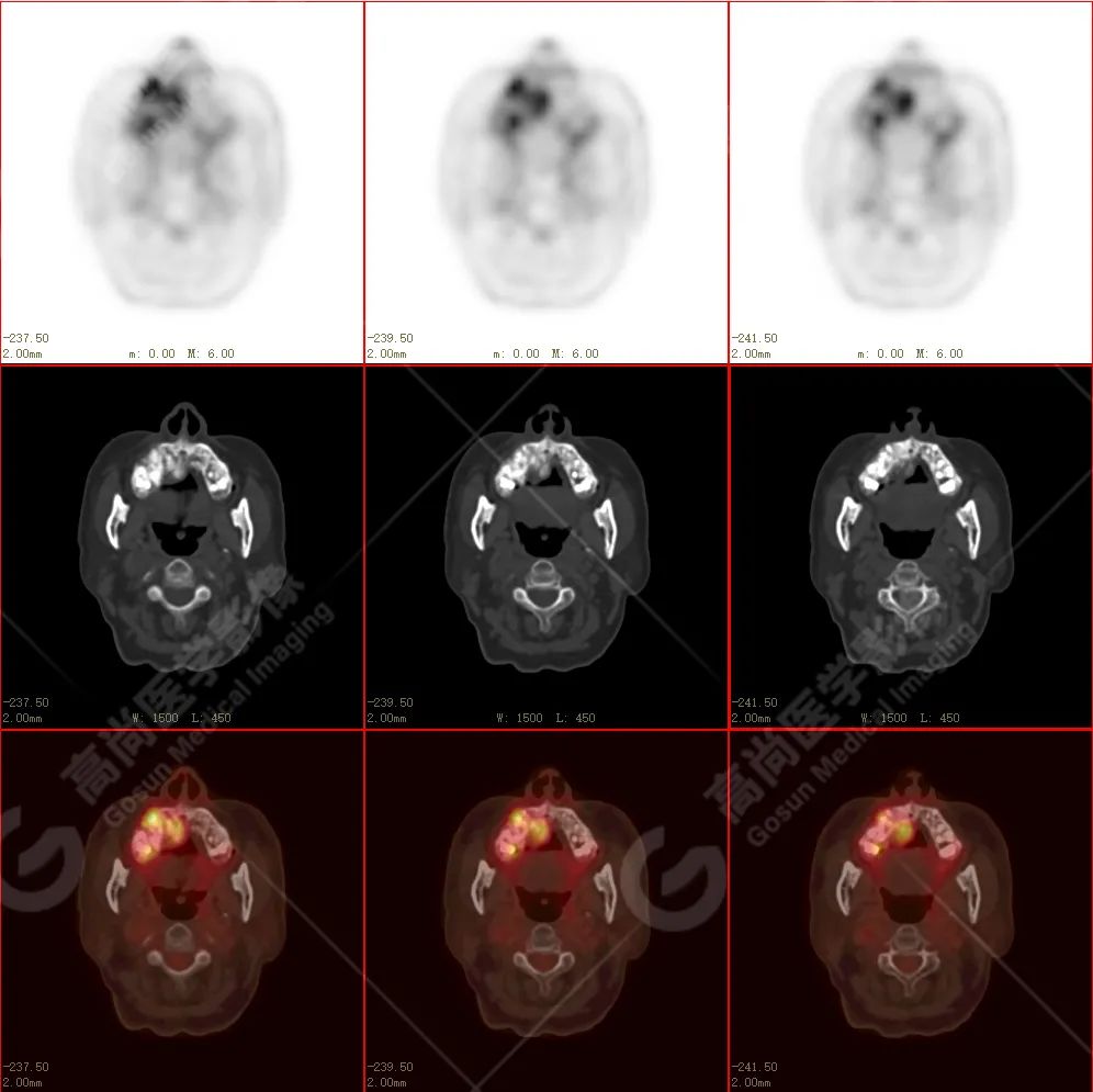 高尚病例：放疗后骨肉瘤一例