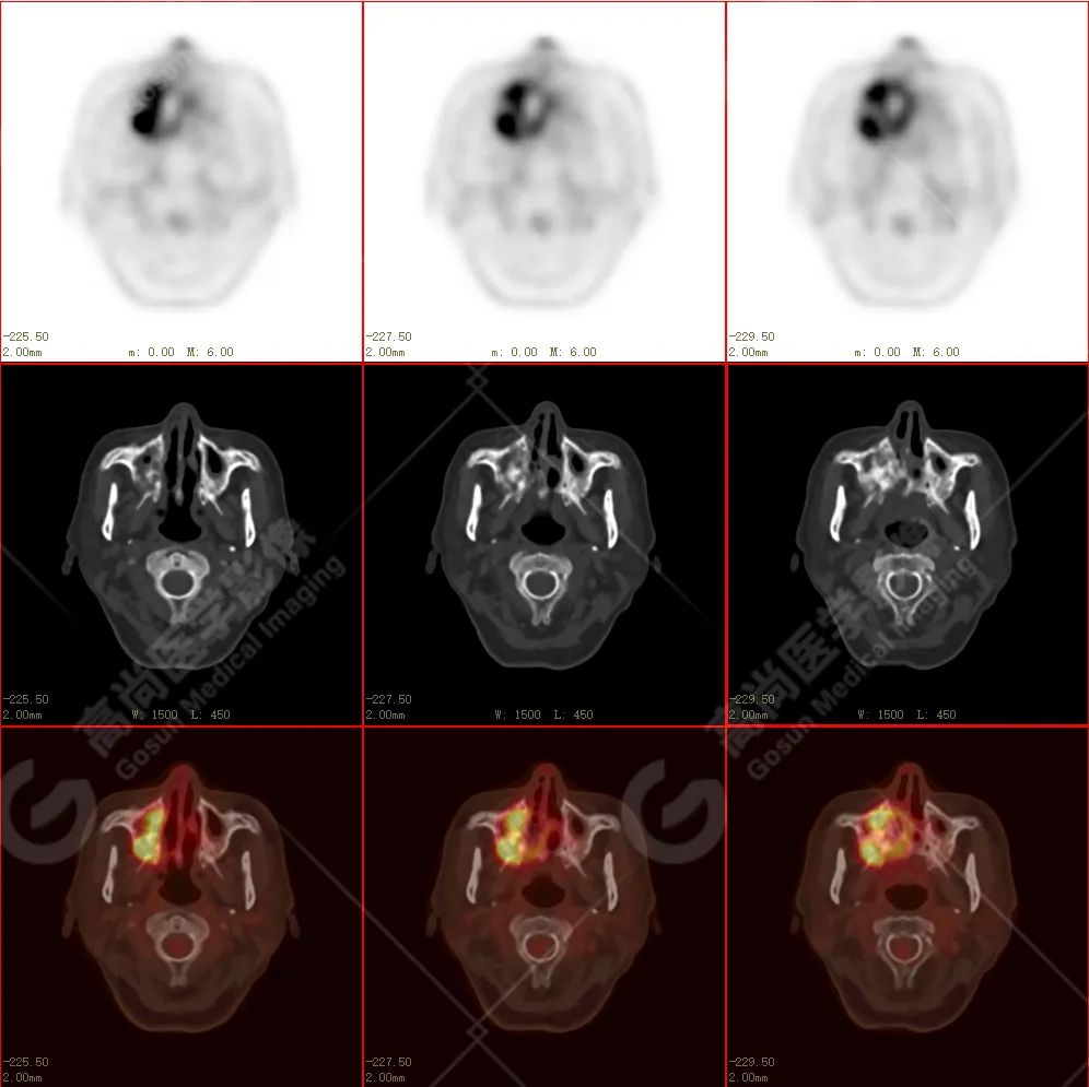 高尚病例：放疗后骨肉瘤一例