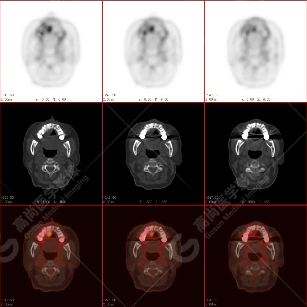 高尚病例：放疗后骨肉瘤一例