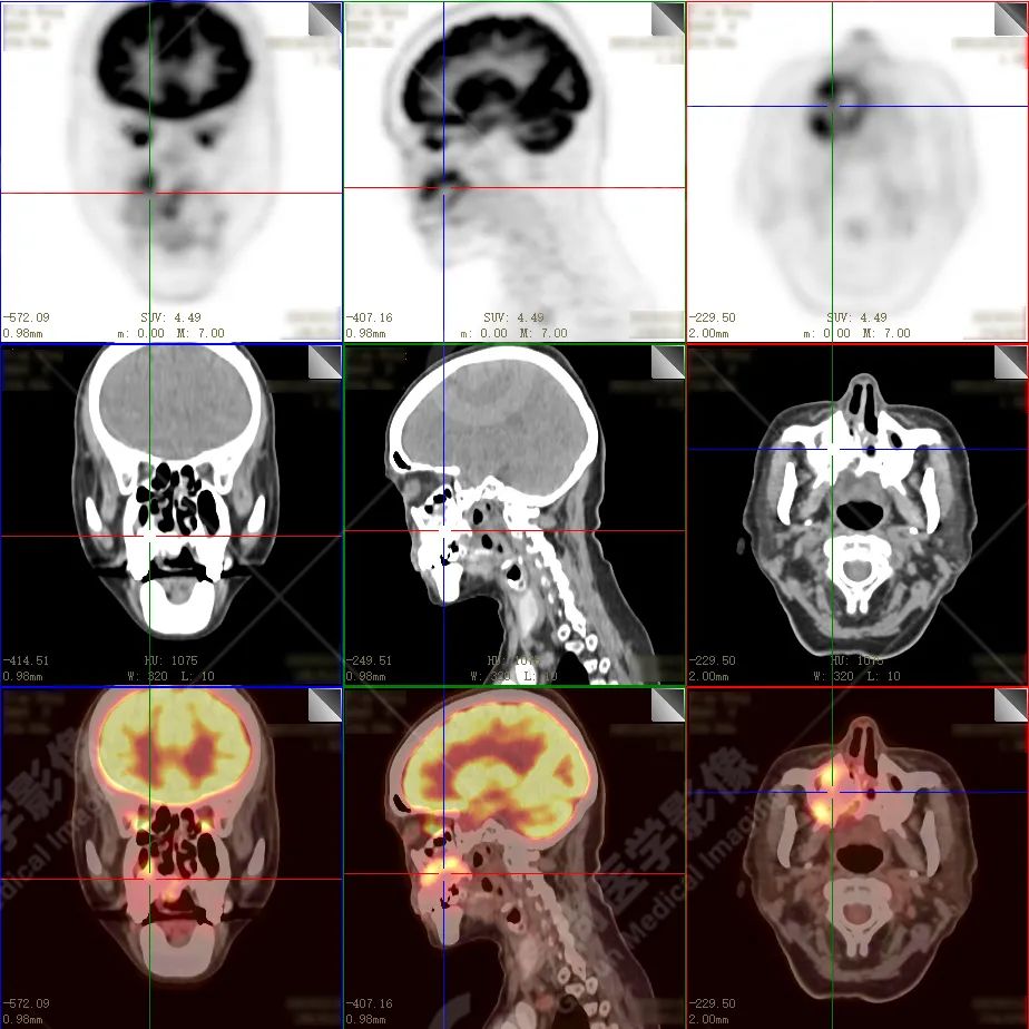 高尚病例：放疗后骨肉瘤一例