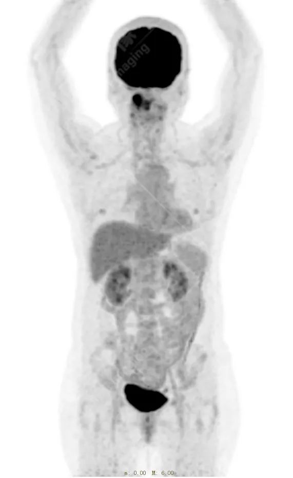 高尚病例：放疗后骨肉瘤一例