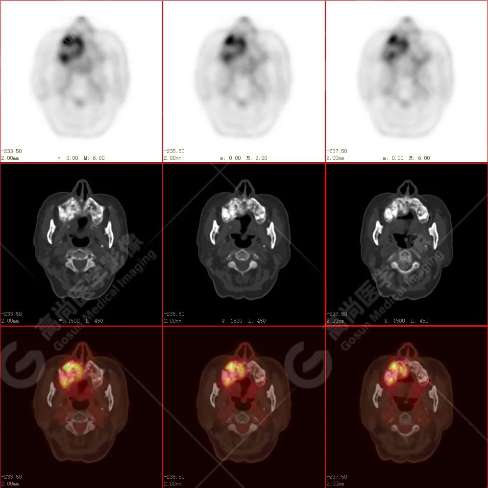 高尚病例：放疗后骨肉瘤一例