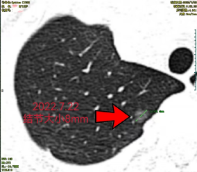 16 岁少年得肺癌！隐形杀手在家里