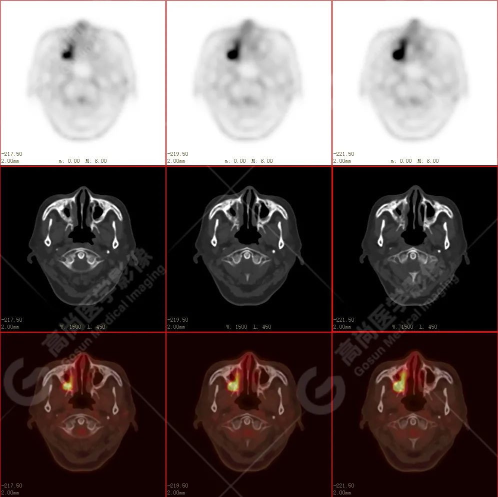 高尚病例：放疗后骨肉瘤一例