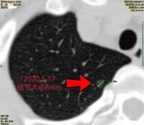 16 岁少年得肺癌！隐形杀手在家里