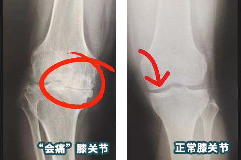 越是铁打的汉子,越是逃不过这种「钻心痛」