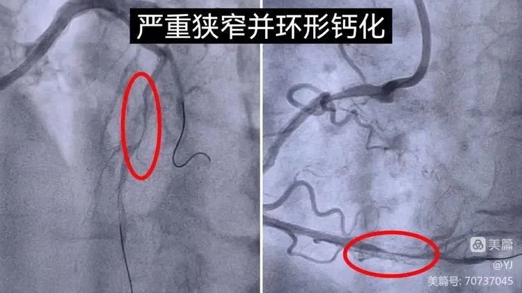 岳池县人民医院首次应用「Shockwave 震波球囊」技术治疗冠状动脉严重钙化病变成功！