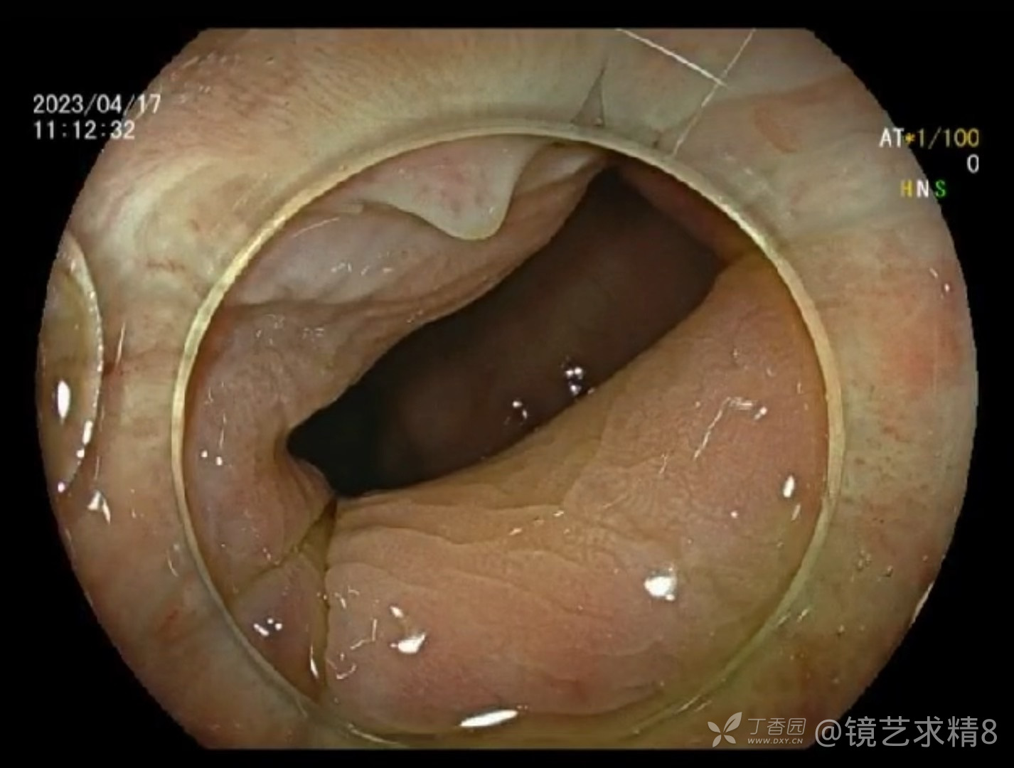 肠镜检查从肛门到回盲部28秒视角