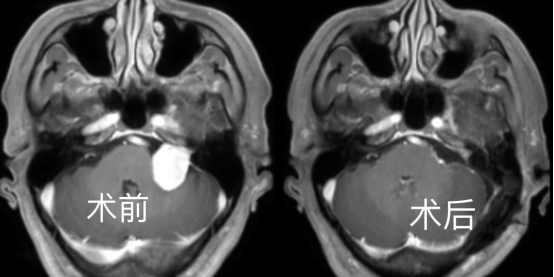 听力下降，伴有耳鸣？警惕听神经瘤