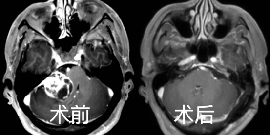 听力下降，伴有耳鸣？警惕听神经瘤