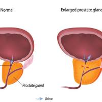 膀胱出口梗阻模型