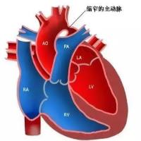 主动脉弓缩窄模型