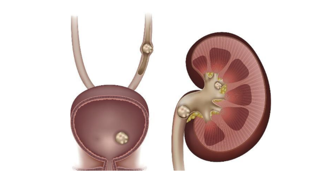 泌尿系结石的痛谁知道？
