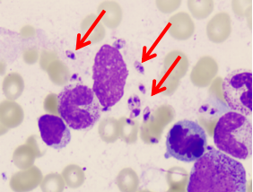 震惊，这个小朋友骨髓中发现小虫虫？