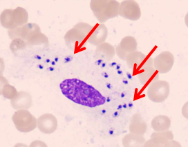震惊，这个小朋友骨髓中发现小虫虫？