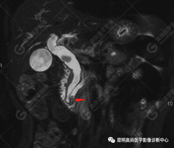 高尚病例：壶腹癌一例