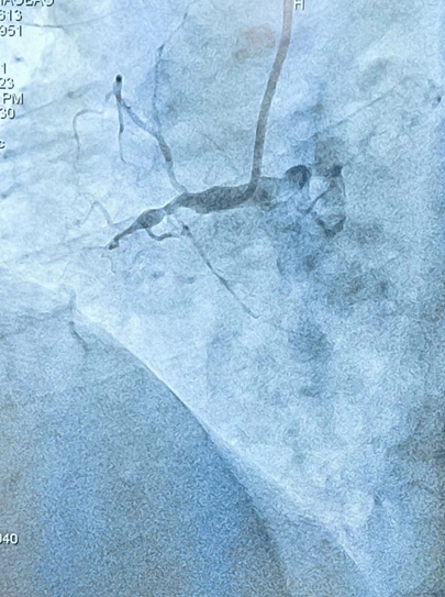 西安市中医医院完成首例 CART 技术开通 CTO 病变手术
