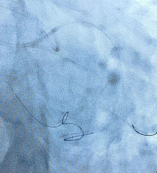 西安市中医医院完成首例 CART 技术开通 CTO 病变手术