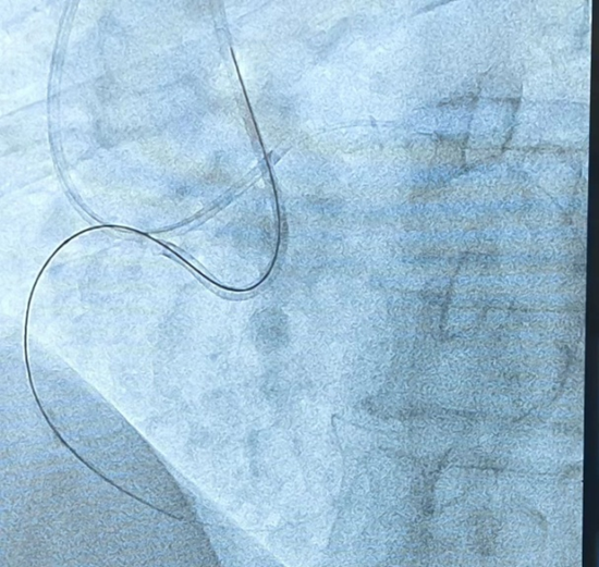 西安市中医医院完成首例 CART 技术开通 CTO 病变手术