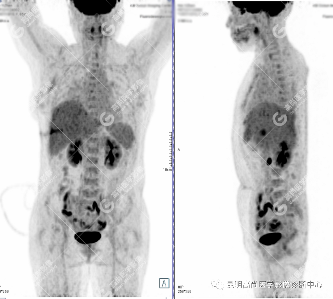 高尚病例：壶腹癌一例