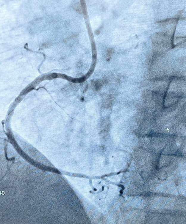 西安市中医医院完成首例 CART 技术开通 CTO 病变手术