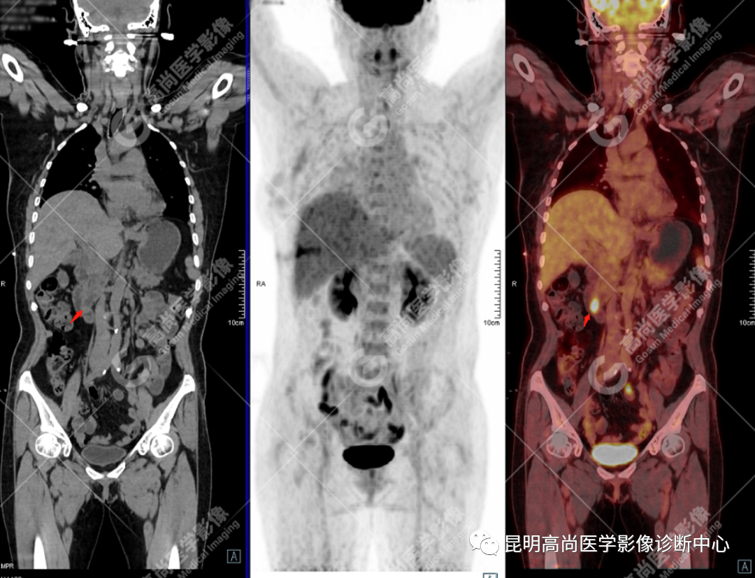 高尚病例：壶腹癌一例