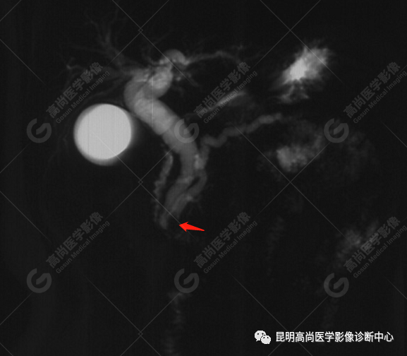 高尚病例：壶腹癌一例