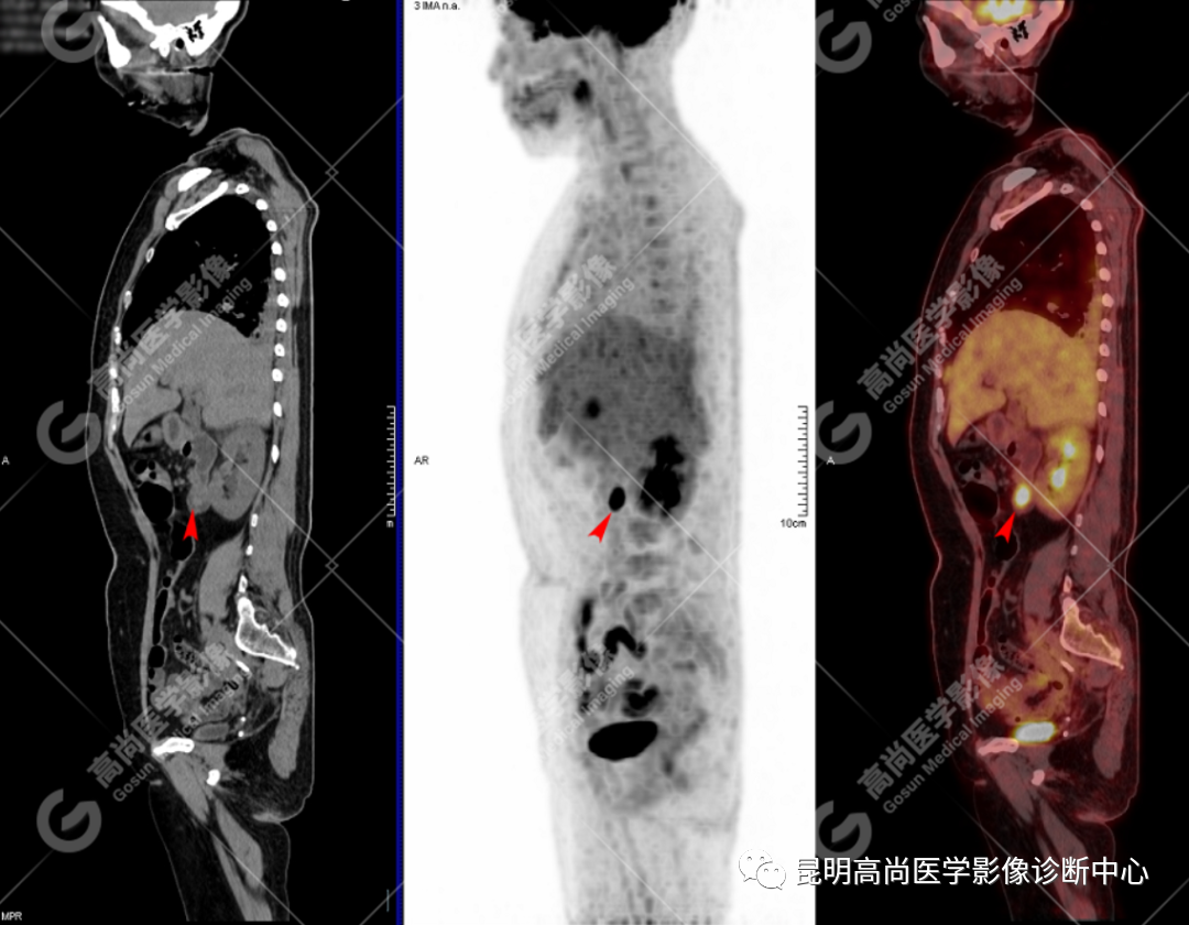 高尚病例：壶腹癌一例
