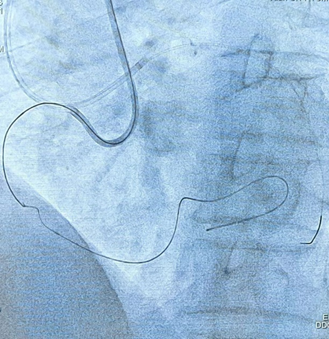 西安市中医医院完成首例 CART 技术开通 CTO 病变手术