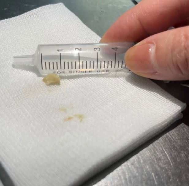 小异物，大凶险！湄潭家礼医院儿科利用电子支气管镜为 1 岁幼儿取出支气管异物
