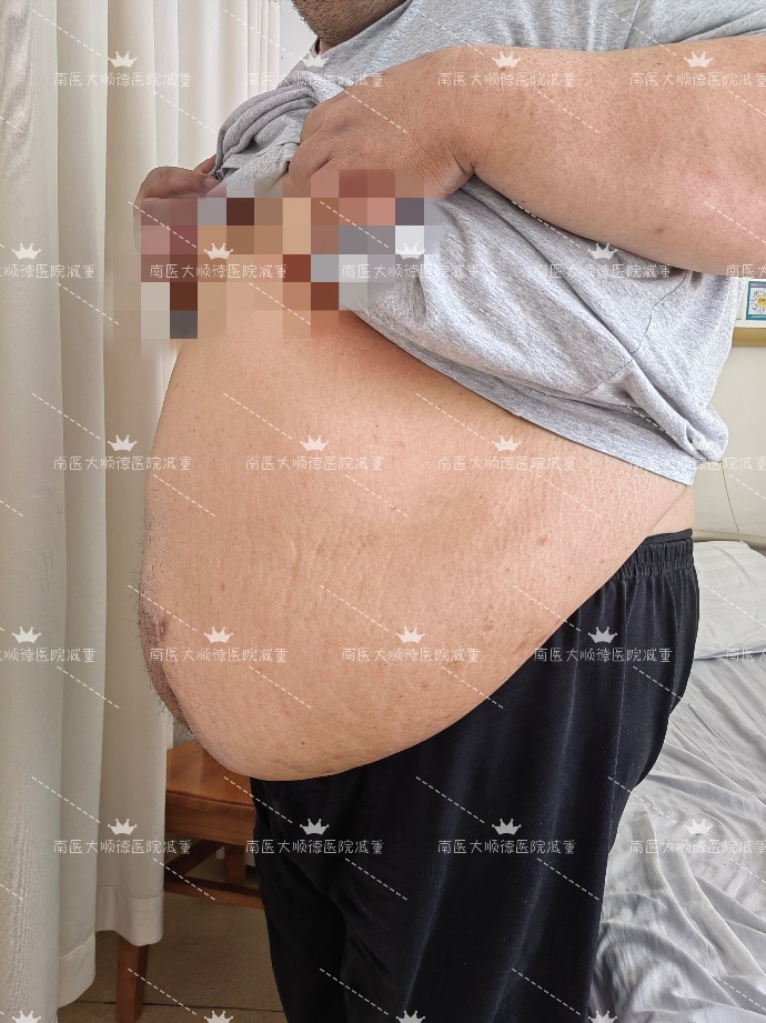 南方医科大学顺德医院胃肠外科：体重 370 斤+的他，有个减重梦