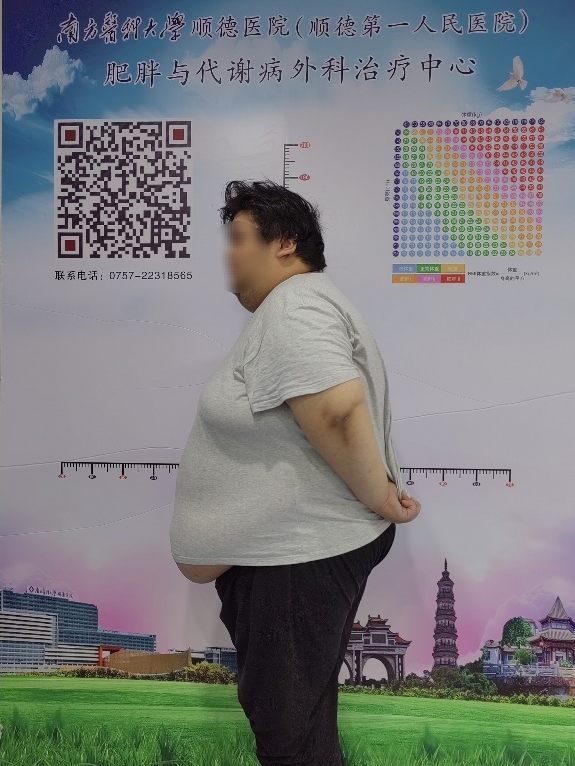南方医科大学顺德医院胃肠外科：体重 370 斤+的他，有个减重梦