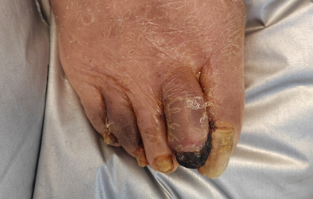 痴呆老人脚趾变「黑炭」!脚疼、发凉,警惕「腿梗」